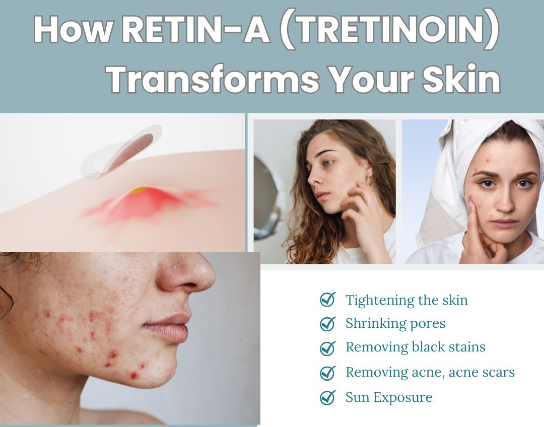 The Ultimate Guide to Tretinoin: Benefits, Usage, and Tips for Success